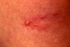 Image result for Gnathostomiasis